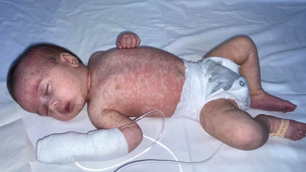 ‘I had no idea measles could make babies so ill’: Parents urged to vaccinate children before start of school year