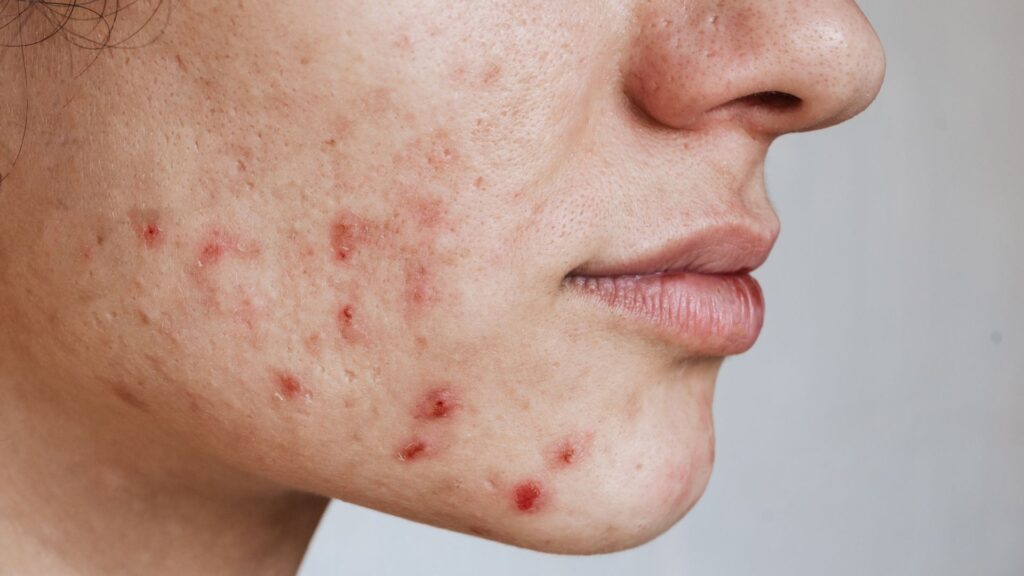 Study names country whose teenagers have the worst acne