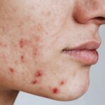 Study names country whose teenagers have the worst acne