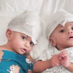 Rare conjoined twin girls separated after 14 hour operation