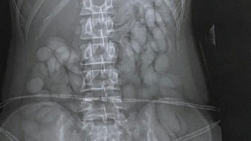 X-ray reveals ‘cocaine bullets’ in woman’s stomach