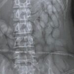 X-ray reveals ‘cocaine bullets’ in woman’s stomach