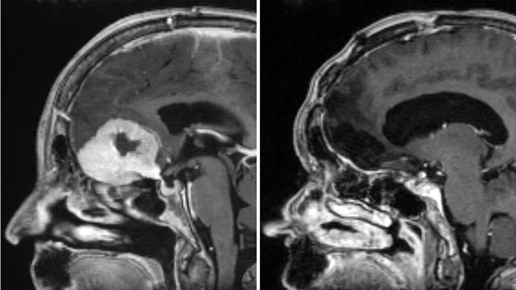 Surgeon removes brain tumours ‘the size of large apples’ through patients’ eyebrows