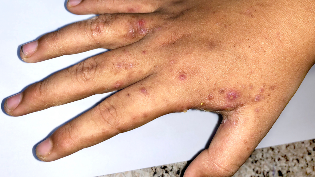 ‘Stigma’ warning over ‘very itchy and irritating’ rash as cases rise