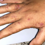 ‘Stigma’ warning over ‘very itchy and irritating’ rash as cases rise