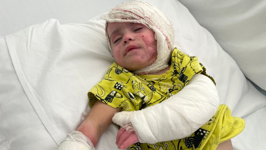 ‘She couldn’t move her mouth’: Baby suffers burns on more than half her body in Israeli airstrike