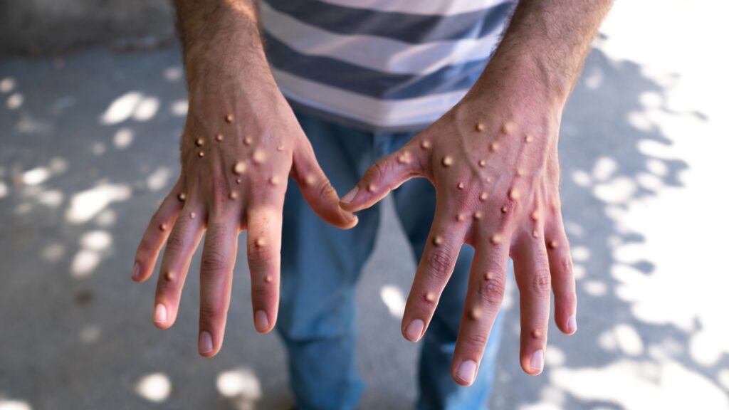 US records first case of new Mpox strain