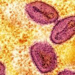 New case of mpox detected in UK