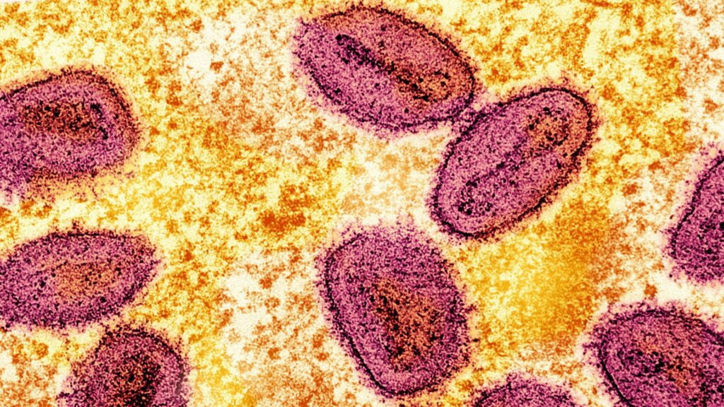 More cases of new mpox strain detected in UK