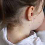 Unvaccinated child dies from measles in first US death from virus since 2015