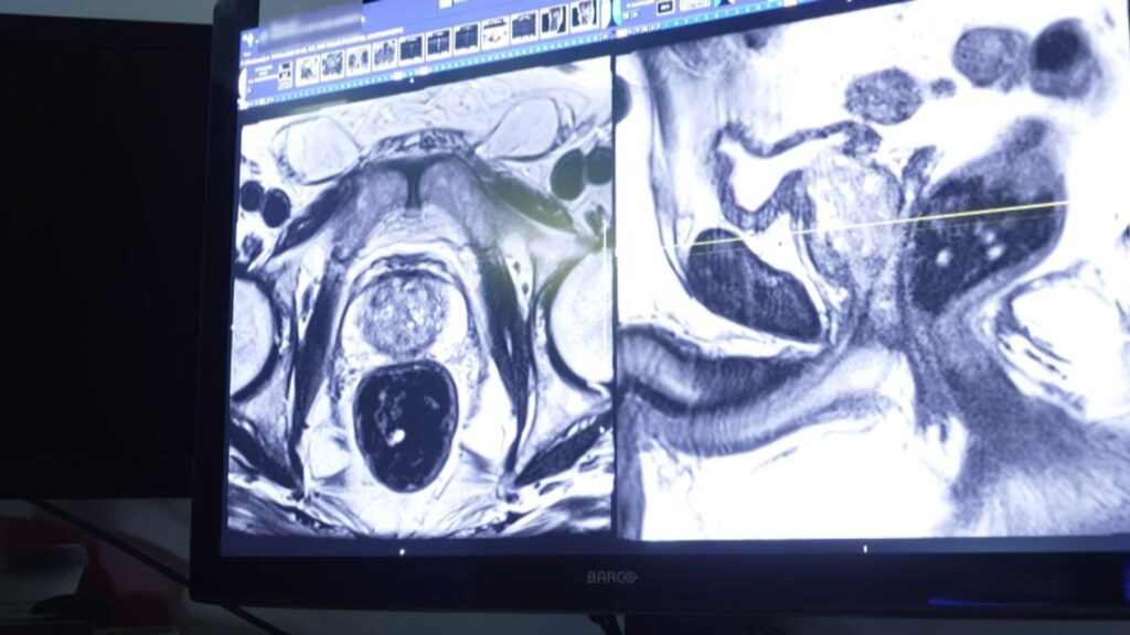 Sharp rise in prostate cancer if ‘tsunami’ of cases not detected sooner, doctor warns